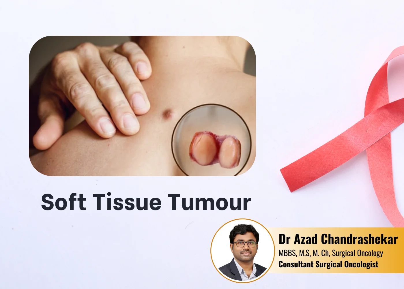 Soft-Tissue-Tumour treatment in Hyderabad